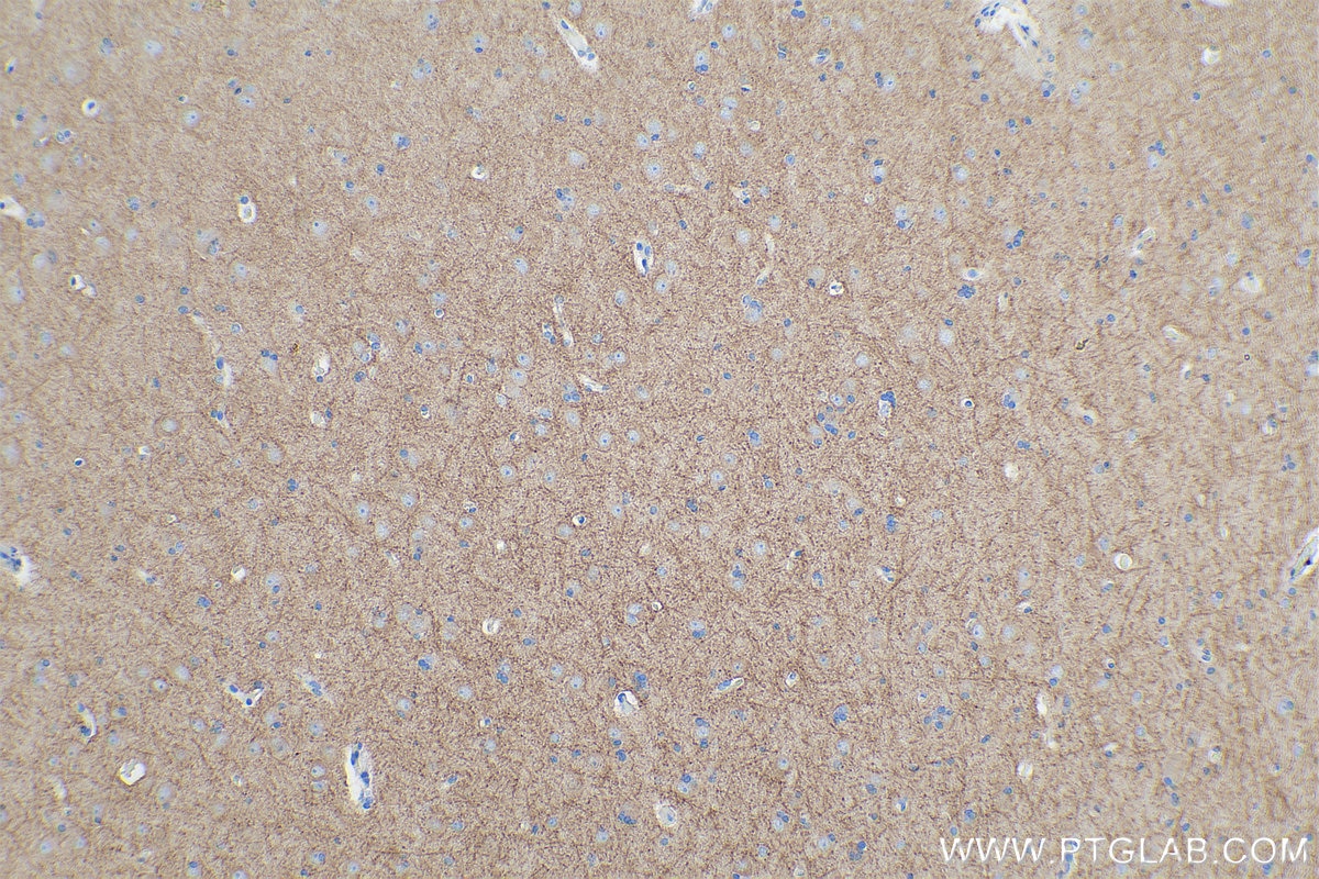 Immunohistochemical analysis of paraffin-embedded human gliomas tissue slide using KHC0848 (DBN1/Drebrin IHC Kit).