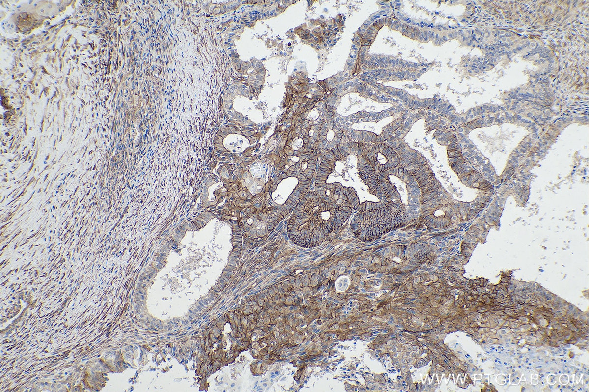 Immunohistochemical analysis of paraffin-embedded human ovary tumor tissue slide using KHC0848 (DBN1/Drebrin IHC Kit).