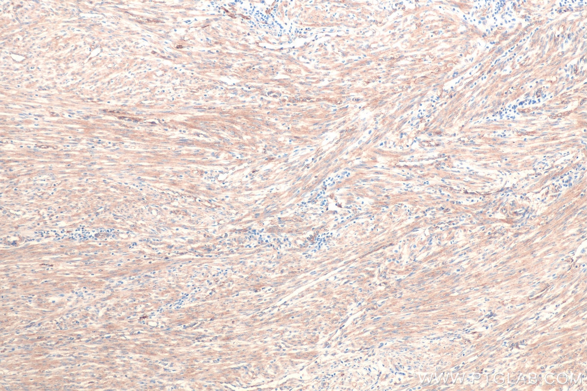 Immunohistochemical analysis of paraffin-embedded human endometrial cancer tissue slide using KHC0848 (DBN1/Drebrin IHC Kit).