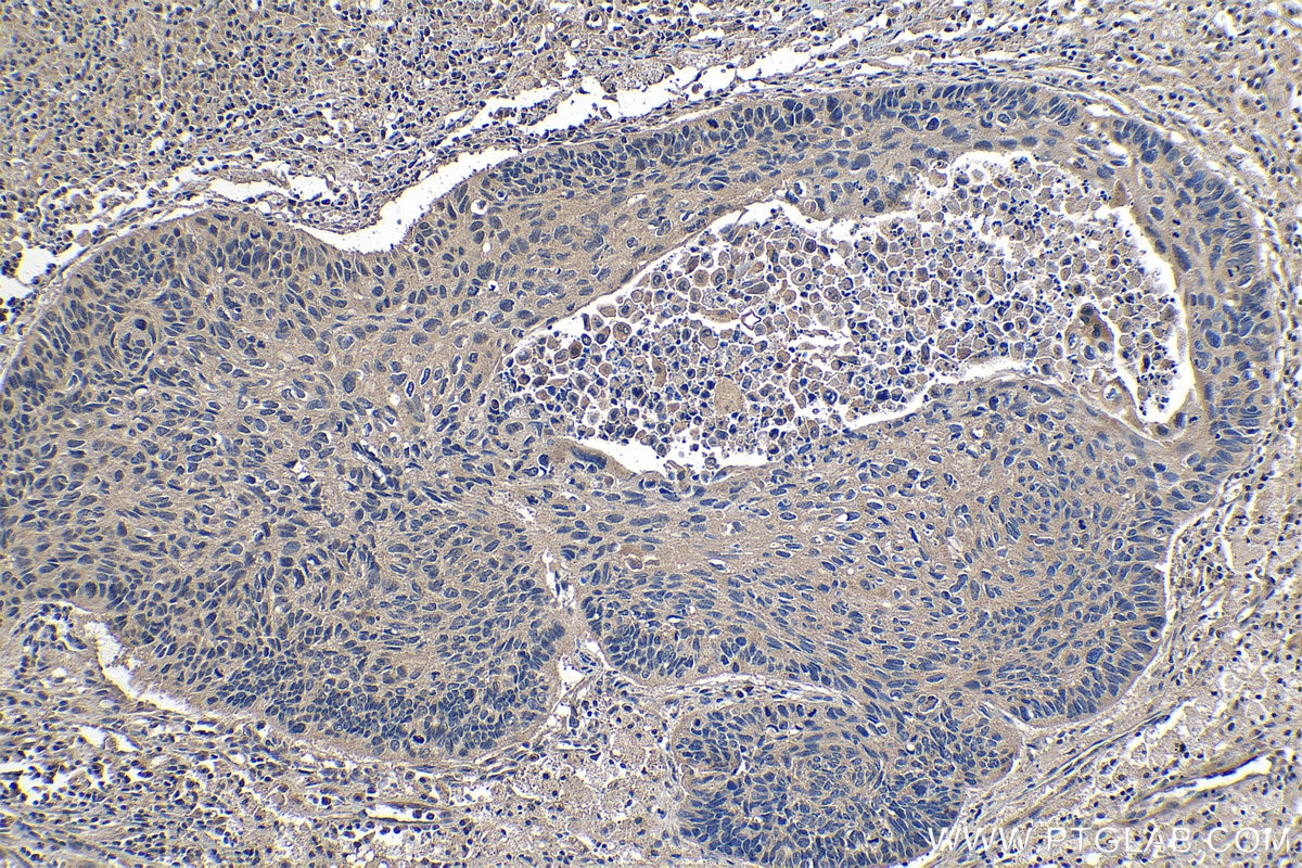 Immunohistochemical analysis of paraffin-embedded human lung cancer tissue slide using KHC1299 (DCAF12 IHC Kit).