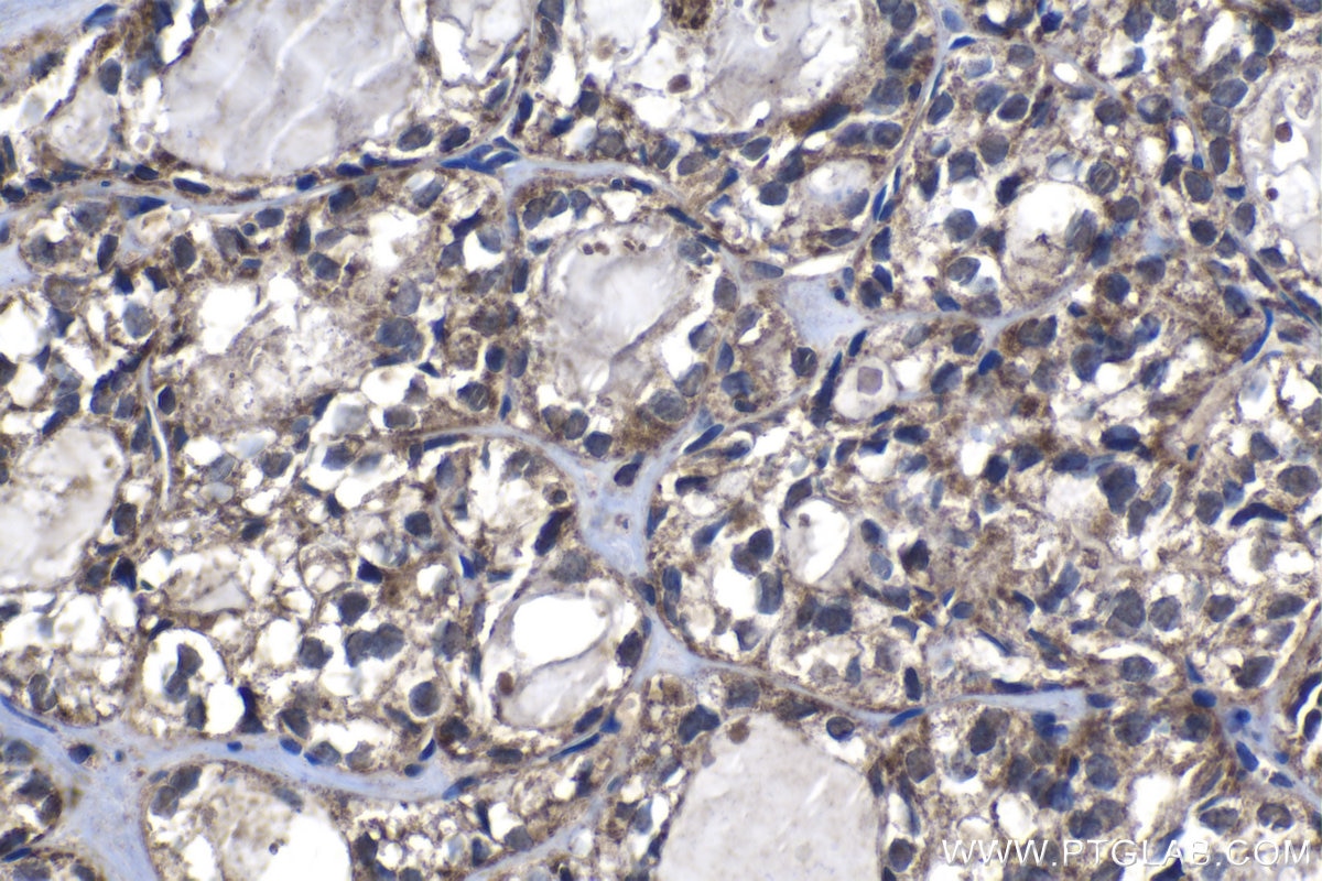 Immunohistochemical analysis of paraffin-embedded human thyroid cancer tissue slide using KHC1299 (DCAF12 IHC Kit).