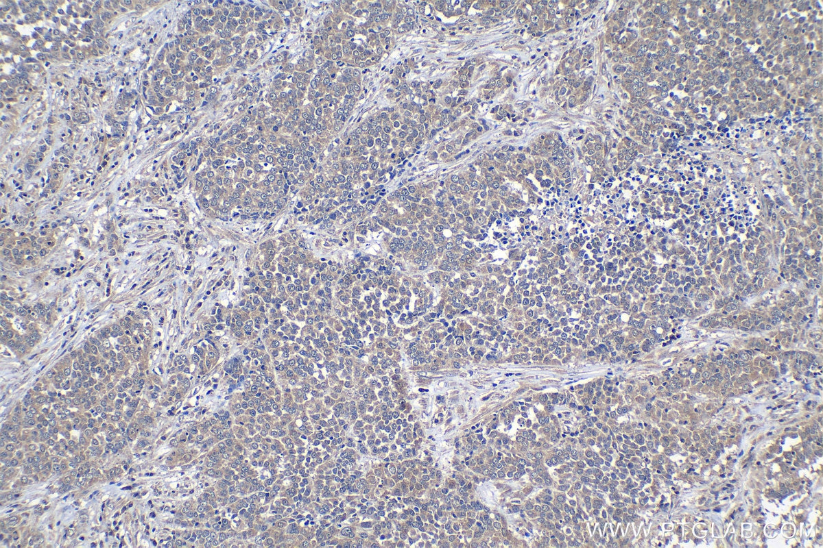 Immunohistochemical analysis of paraffin-embedded human ovary tumor tissue slide using KHC1299 (DCAF12 IHC Kit).