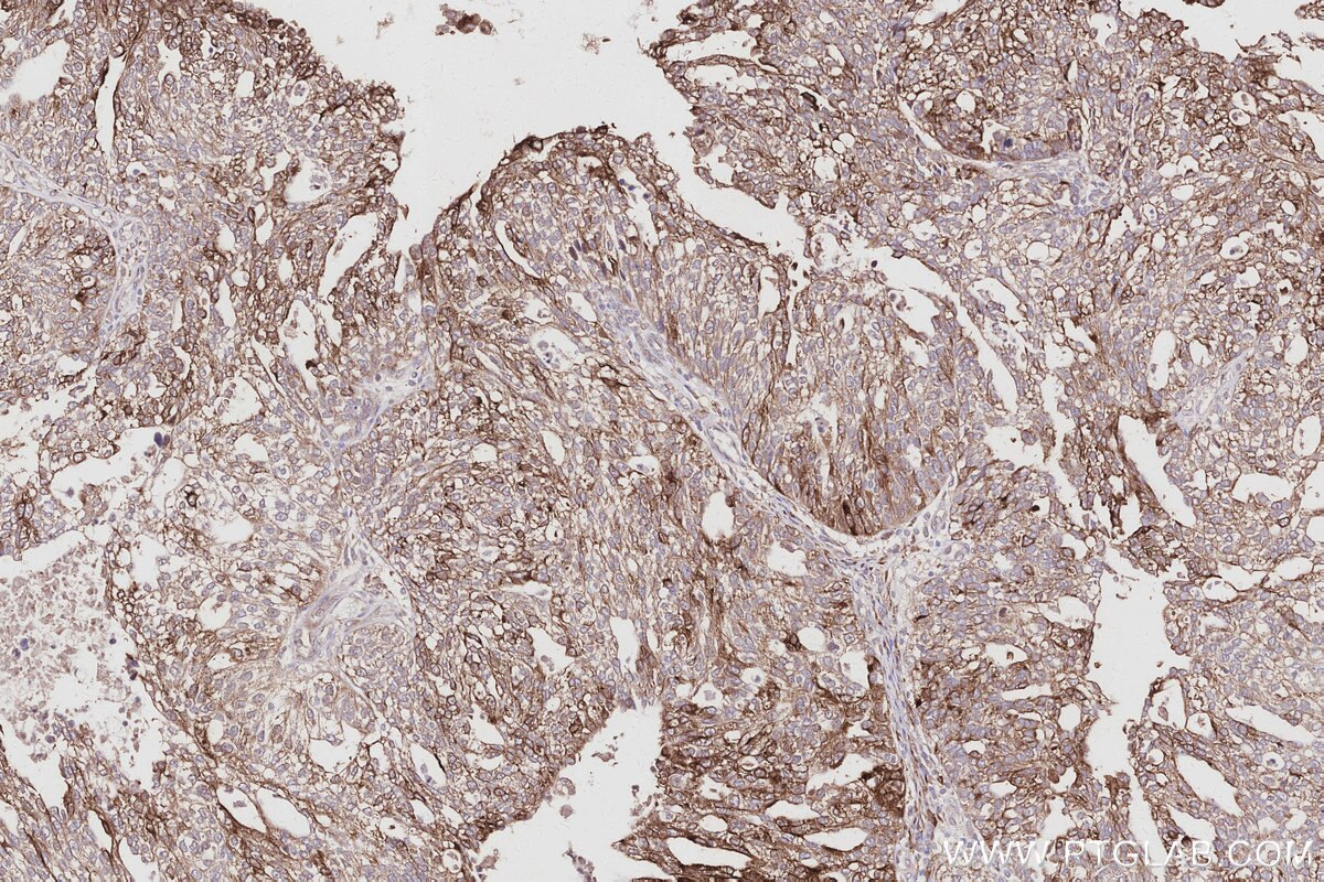 Immunohistochemical analysis of paraffin-embedded human ovary cancer tissue slide using KHC3009 (DCDC2 IHC Kit).