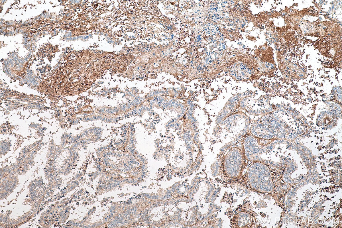 Immunohistochemical analysis of paraffin-embedded human ovary tumor tissue slide using KHC0680 (DCN IHC Kit).
