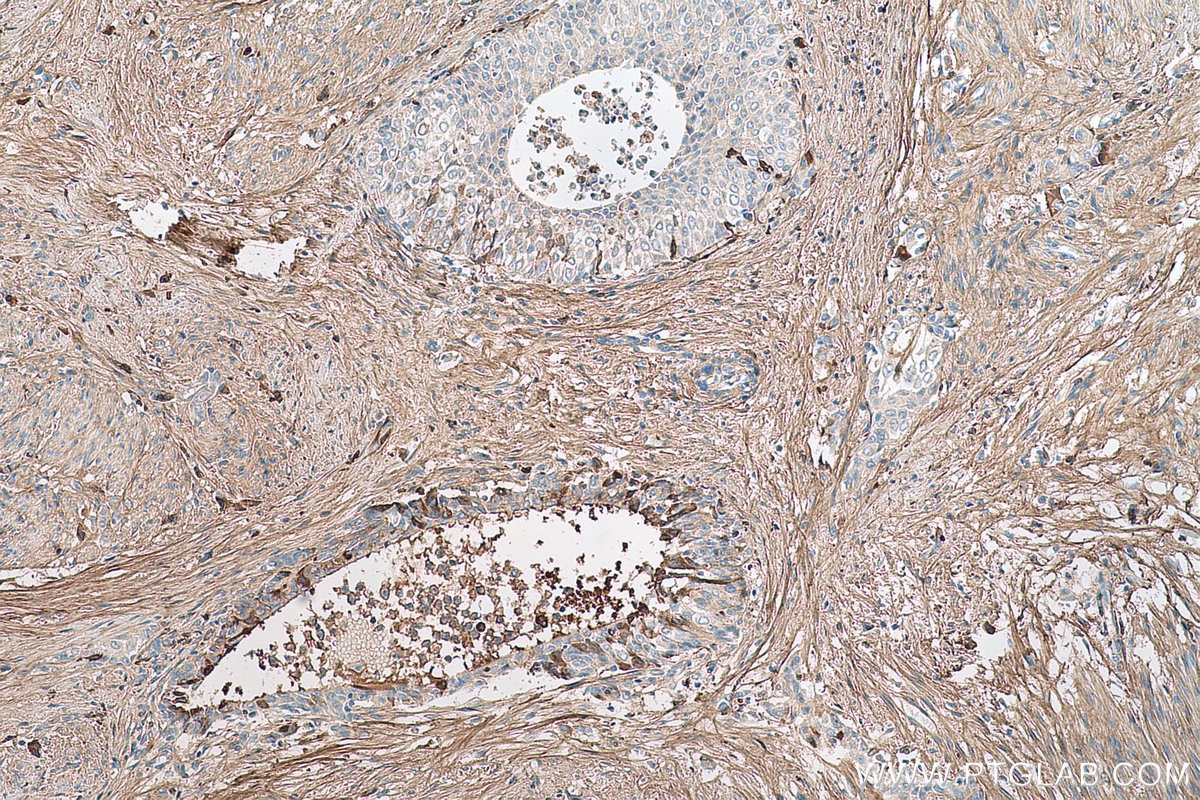 Immunohistochemical analysis of paraffin-embedded human urothelial carcinoma tissue slide using KHC0680 (DCN IHC Kit).