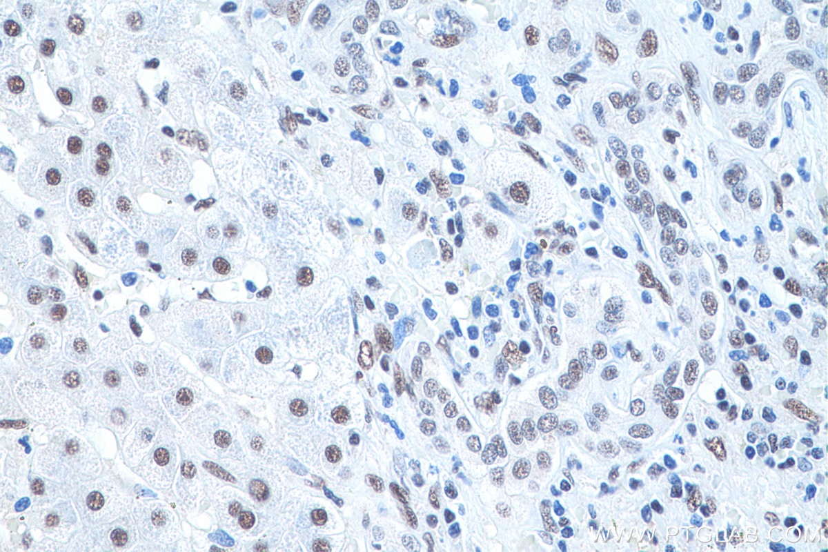 Immunohistochemical analysis of paraffin-embedded human liver cancer tissue slide using KHC0923 (DCPS IHC Kit).
