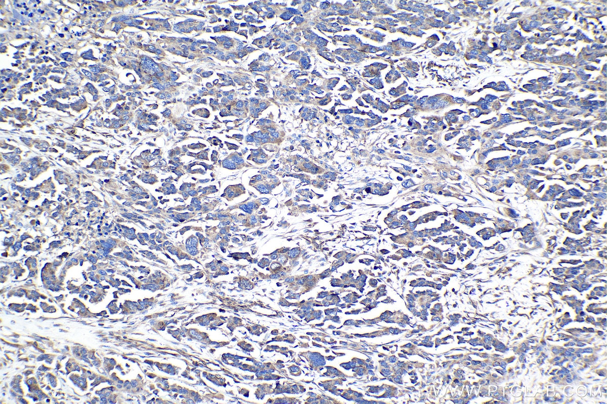 Immunohistochemical analysis of paraffin-embedded human colon cancer tissue slide using KHC0988 (DCTN1 IHC Kit).