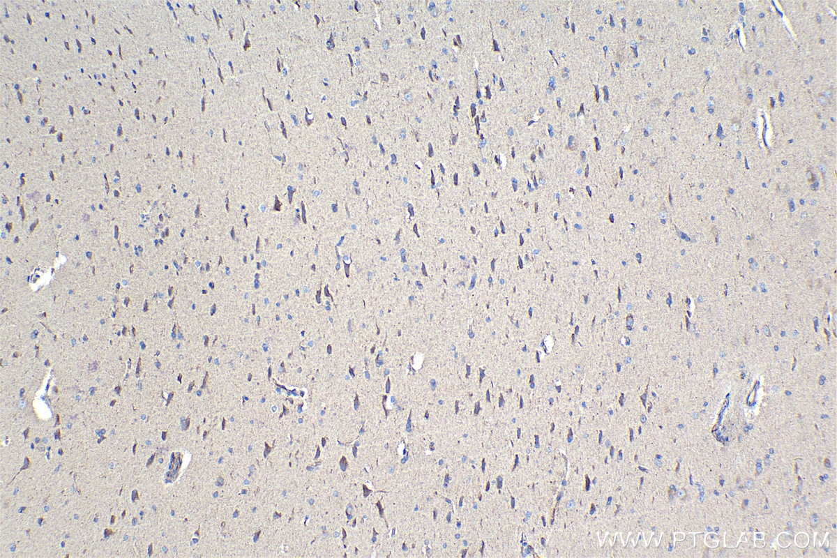 Immunohistochemical analysis of paraffin-embedded human gliomas tissue slide using KHC0988 (DCTN1 IHC Kit).