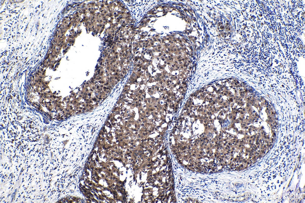 Immunohistochemical analysis of paraffin-embedded human breast cancer tissue slide using KHC1183 (DCTPP1 IHC Kit).