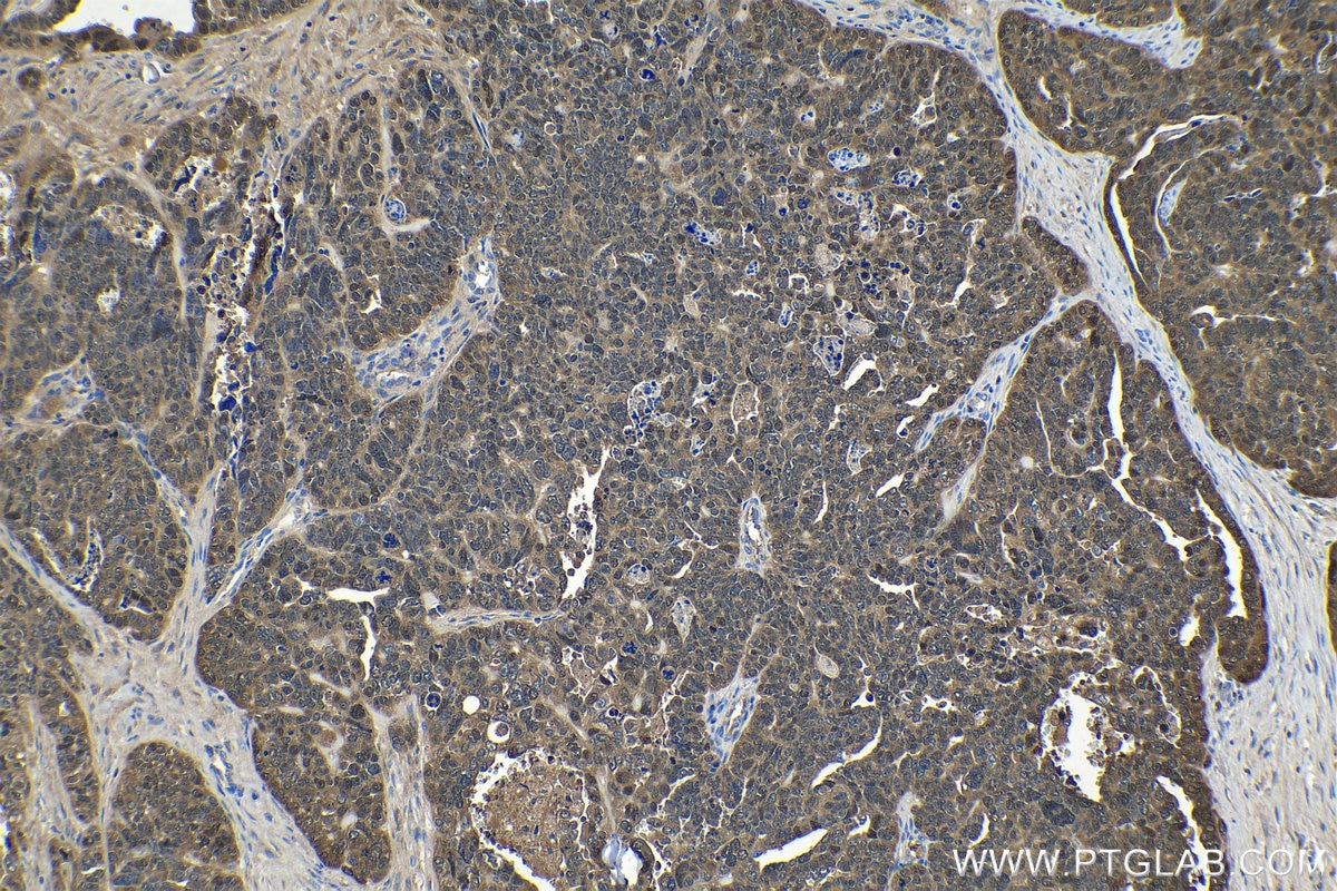 Immunohistochemical analysis of paraffin-embedded human ovary tumor tissue slide using KHC1183 (DCTPP1 IHC Kit).