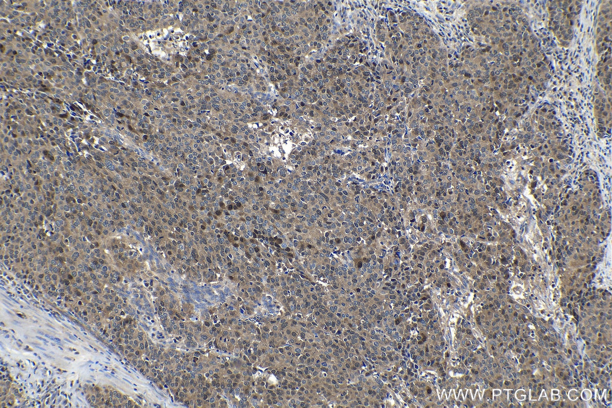 Immunohistochemical analysis of paraffin-embedded human stomach cancer tissue slide using KHC1183 (DCTPP1 IHC Kit).