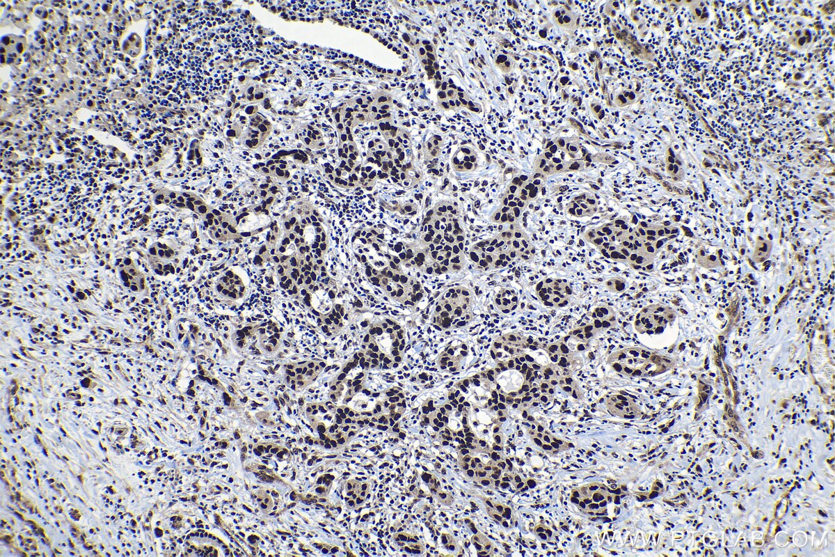 Immunohistochemical analysis of paraffin-embedded human lung cancer tissue slide using KHC1190 (DDA1 IHC Kit).