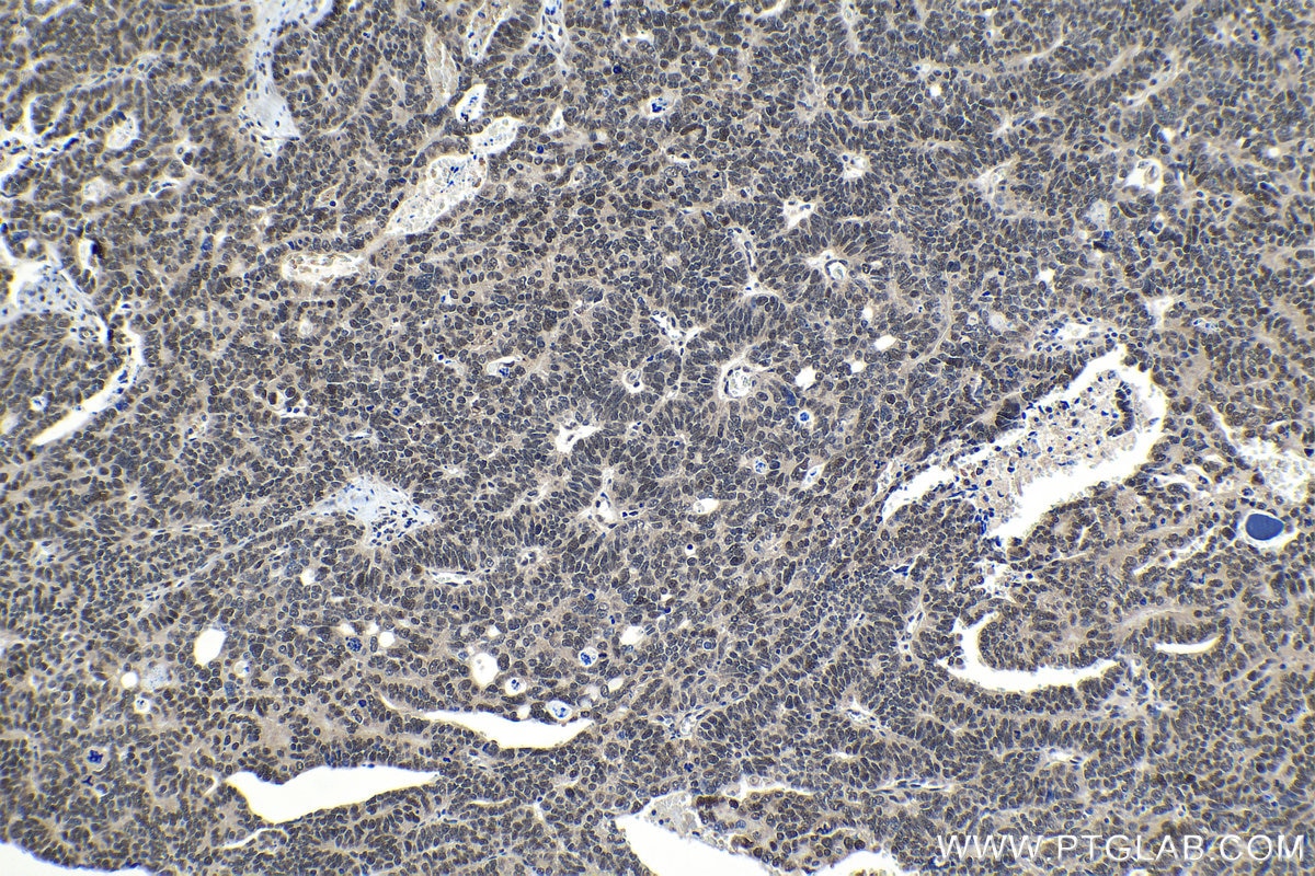 Immunohistochemical analysis of paraffin-embedded human ovary tumor tissue slide using KHC1190 (DDA1 IHC Kit).