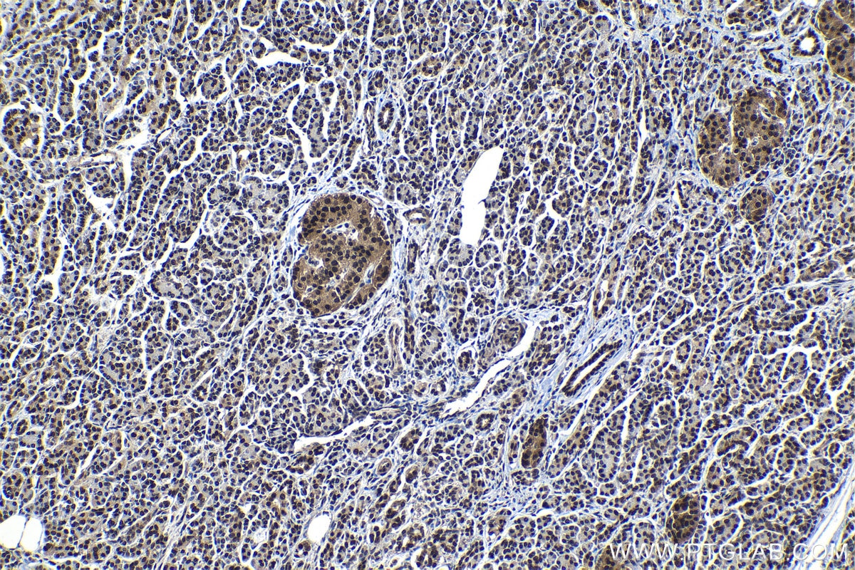Immunohistochemical analysis of paraffin-embedded human pancreas cancer tissue slide using KHC1190 (DDA1 IHC Kit).