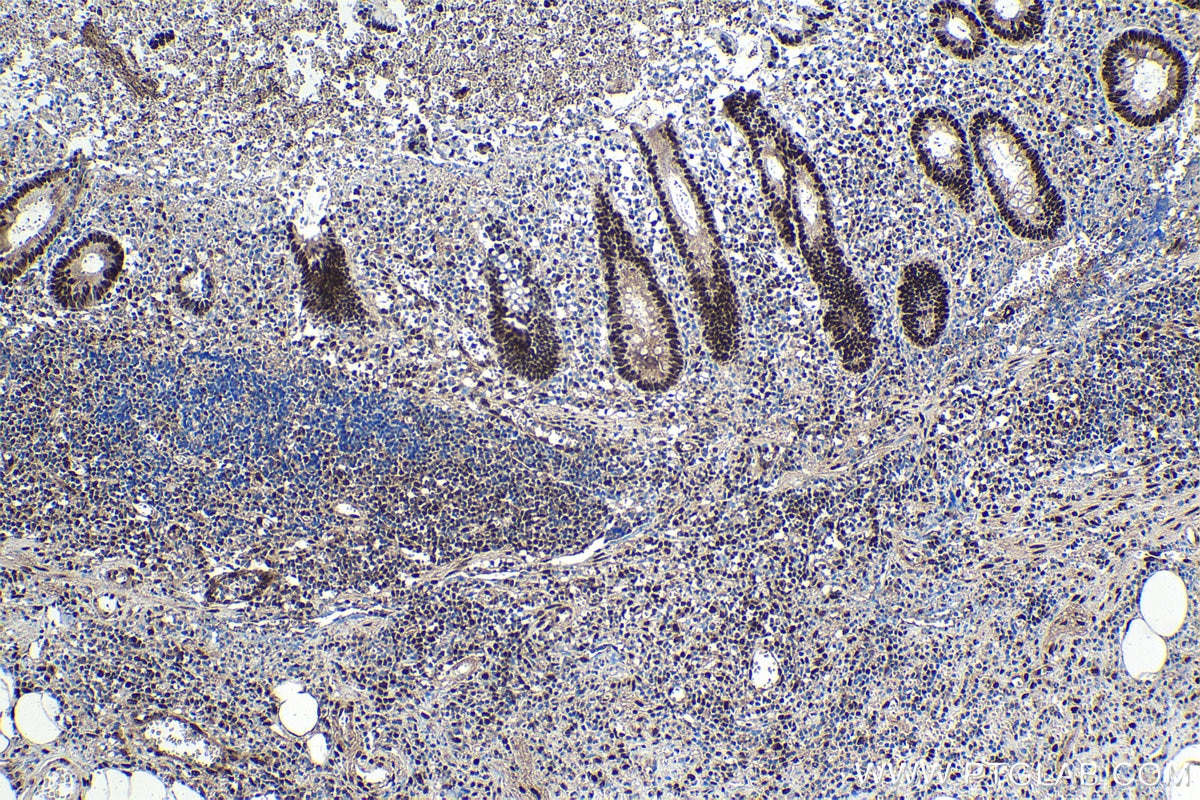 Immunohistochemical analysis of paraffin-embedded human appendicitis tissue slide using KHC1760 (DDB1 IHC Kit).