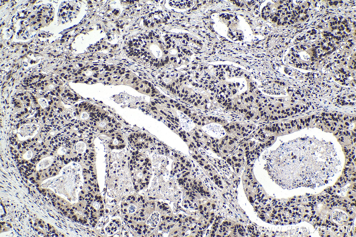 Immunohistochemical analysis of paraffin-embedded human stomach cancer tissue slide using KHC1760 (DDB1 IHC Kit).