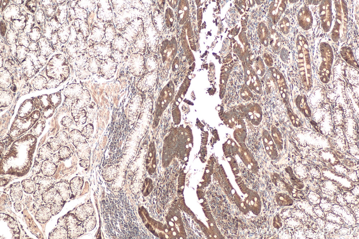 Immunohistochemical analysis of paraffin-embedded human stomach cancer tissue slide using KHC0611 (DDC IHC Kit).