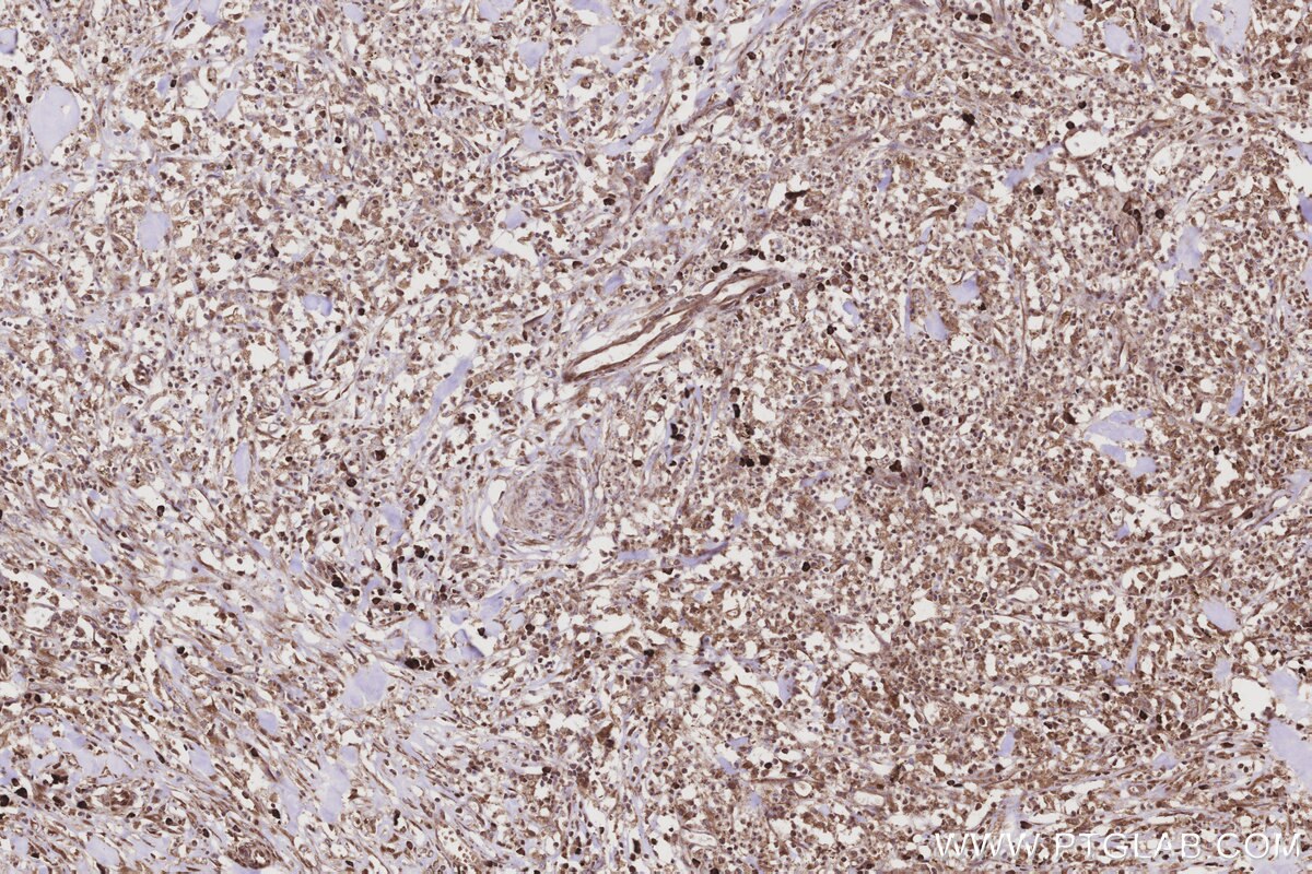 Immunohistochemical analysis of paraffin-embedded human colon cancer tissue slide using KHC3208 (DDOST IHC Kit). Immunohistochemical analysis of paraffin-embedded human colon cancer tissue slide using KHC3208 (DDOST IHC Kit).