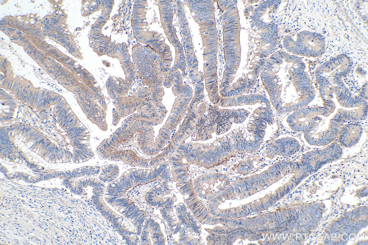 Immunohistochemical analysis of paraffin-embedded human colon cancer tissue slide using KHC0129 (DDR1 IHC Kit).