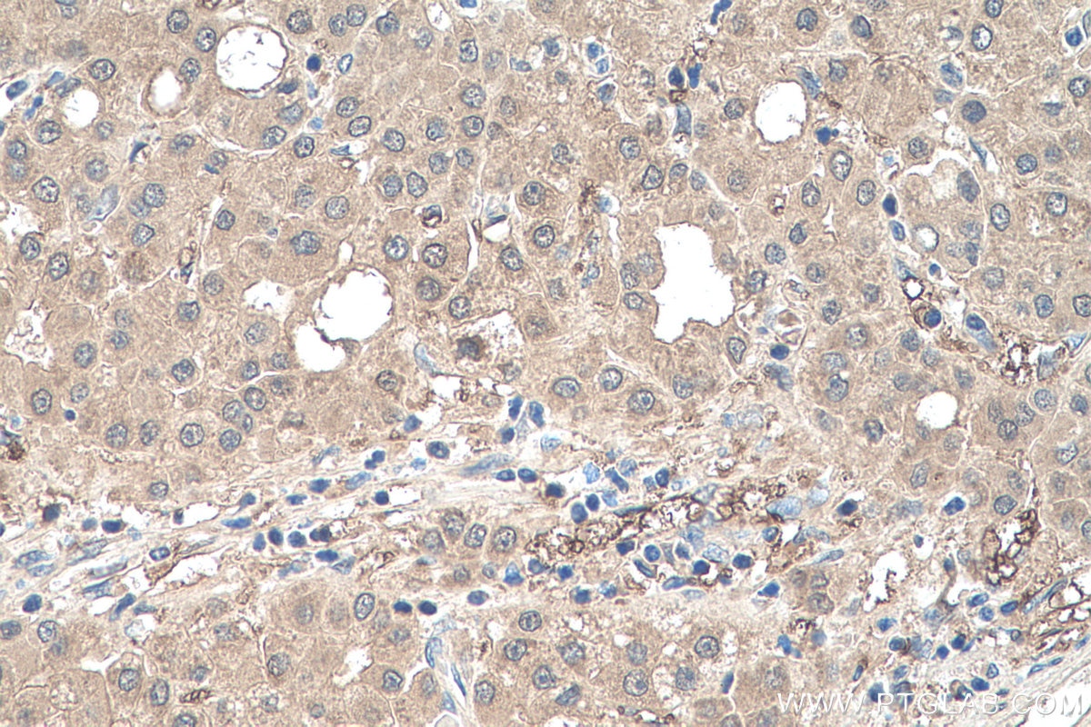 Immunohistochemical analysis of paraffin-embedded human liver cancer tissue slide using KHC0527 (DDT IHC Kit).