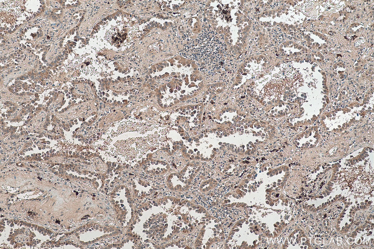 Immunohistochemical analysis of paraffin-embedded human lung cancer tissue slide using KHC0527 (DDT IHC Kit).