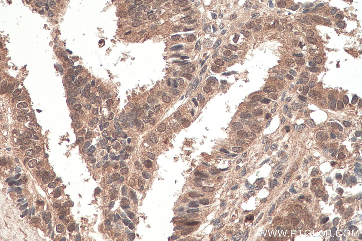 Immunohistochemical analysis of paraffin-embedded human ovary tumor tissue slide using KHC0527 (DDT IHC Kit).
