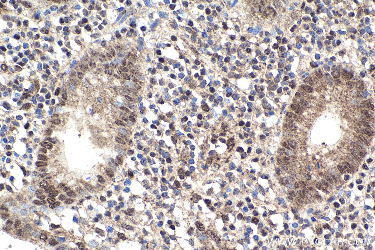 Immunohistochemical analysis of paraffin-embedded human appendicitis tissue slide using KHC1859 (DDX17 IHC Kit).