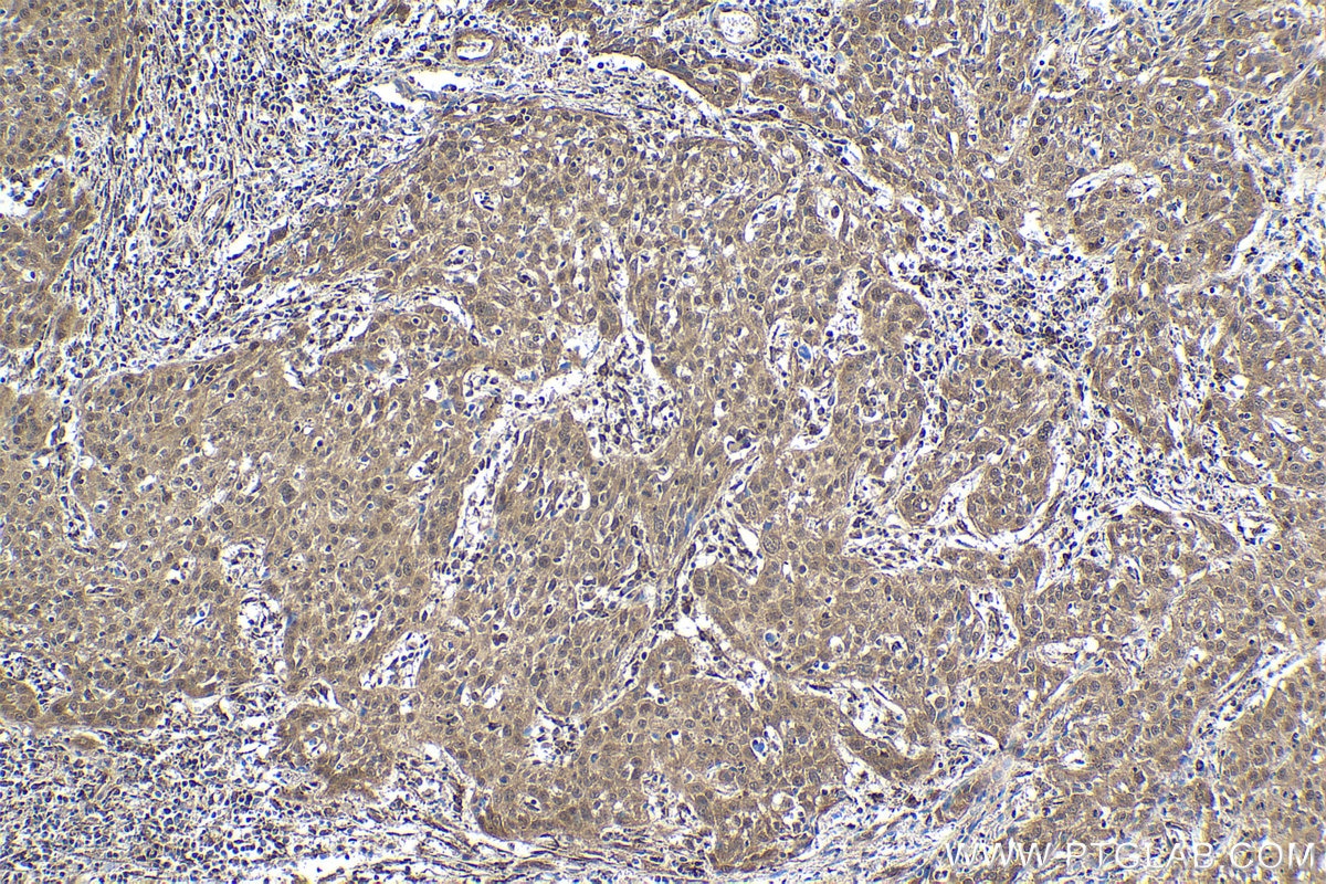 Immunohistochemical analysis of paraffin-embedded human cervical cancer tissue slide using KHC1859 (DDX17 IHC Kit).