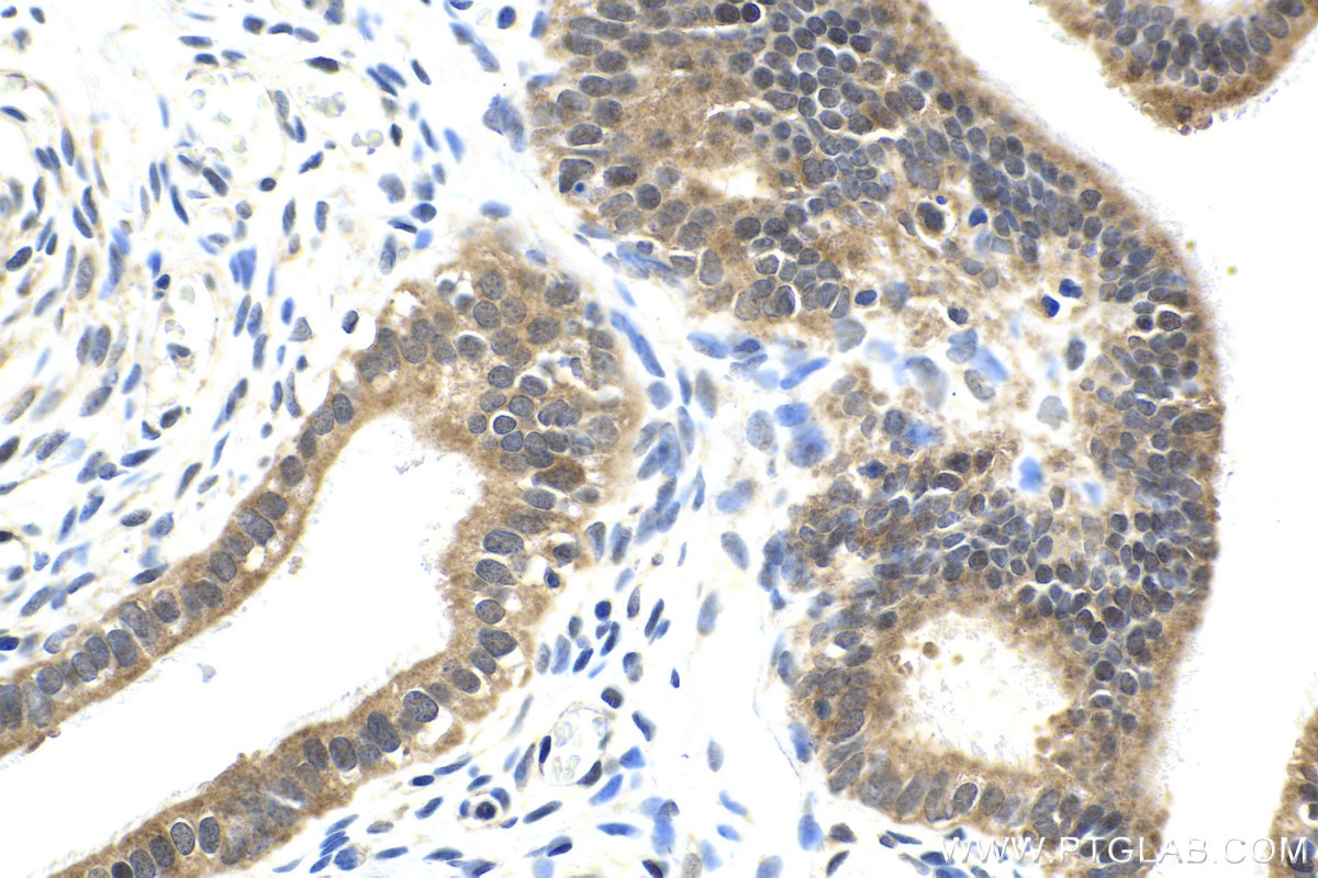 Immunohistochemical analysis of paraffin-embedded human ovary tumor tissue slide using KHC1983 (DDX20 IHC Kit).