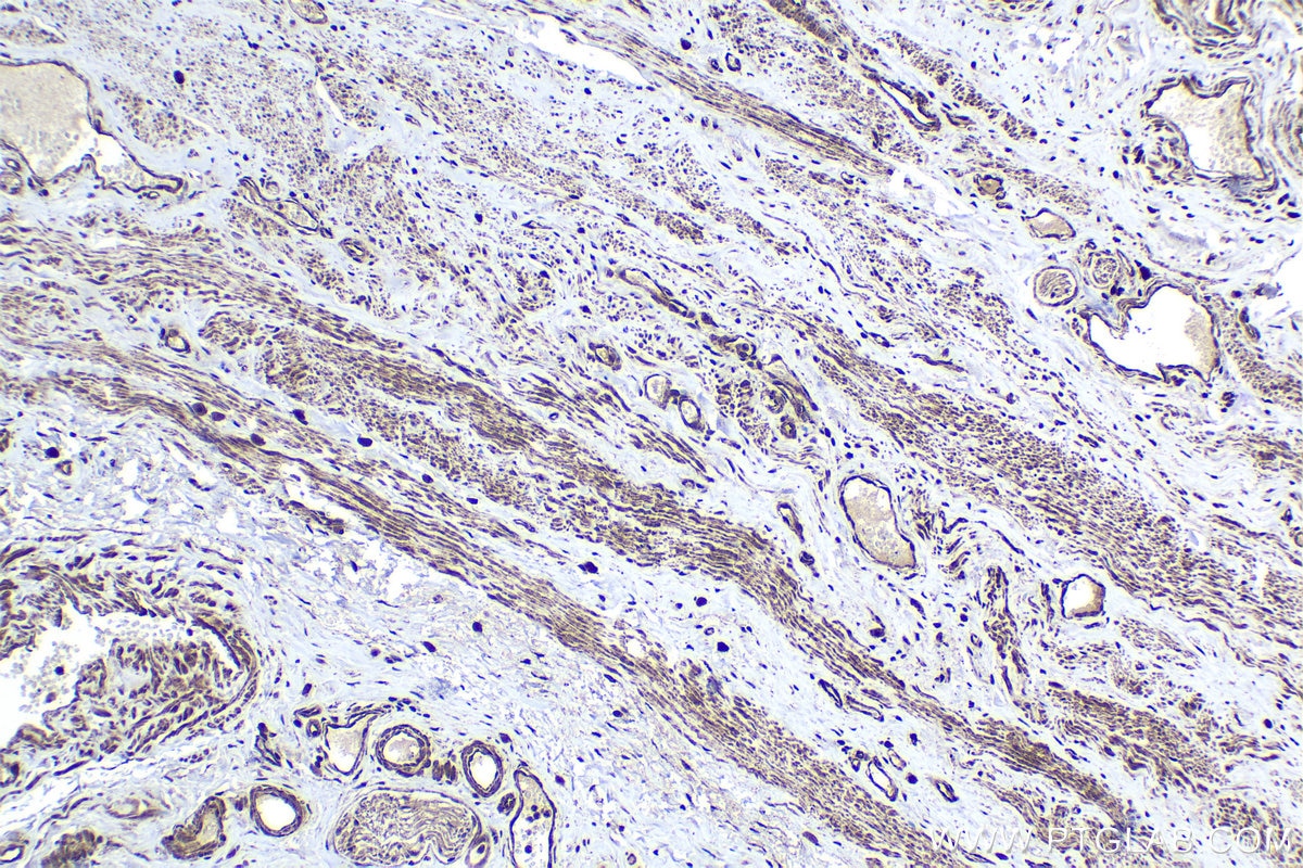 Immunohistochemical analysis of paraffin-embedded human cervical cancer tissue slide using KHC1424 (DDX3 IHC Kit).