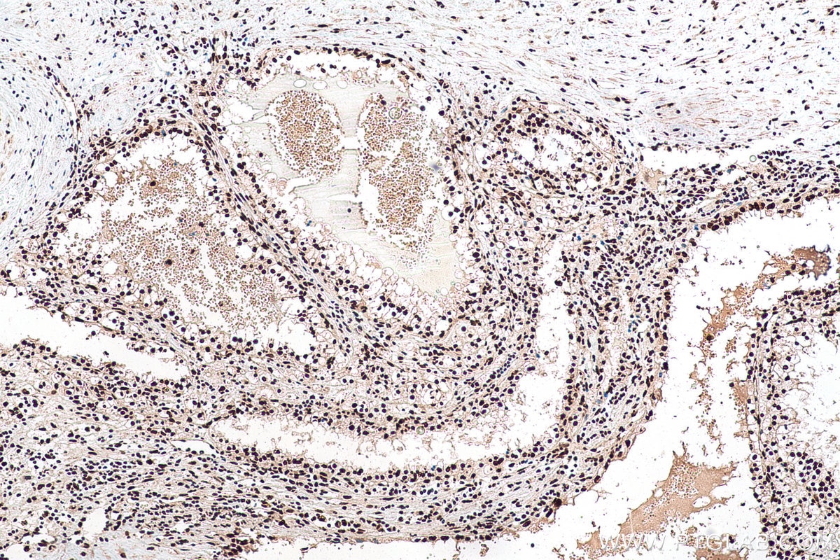 Immunohistochemical analysis of paraffin-embedded human renal cell carcinoma tissue slide using KHC0928 (DDX39A IHC Kit).