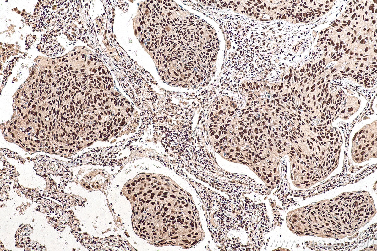 Immunohistochemical analysis of paraffin-embedded human lung cancer tissue slide using KHC0928 (DDX39A IHC Kit).