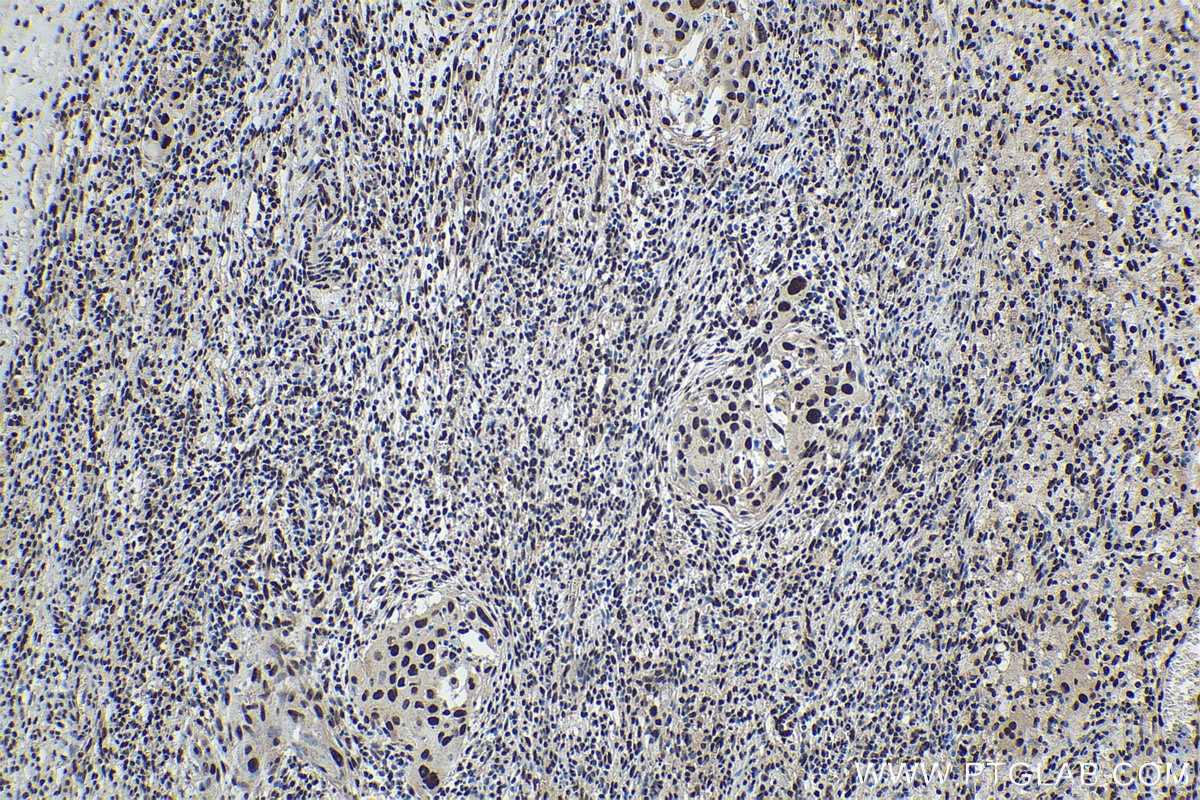 Immunohistochemical analysis of paraffin-embedded human cervical cancer tissue slide using KHC1720 (DDX39B IHC Kit).