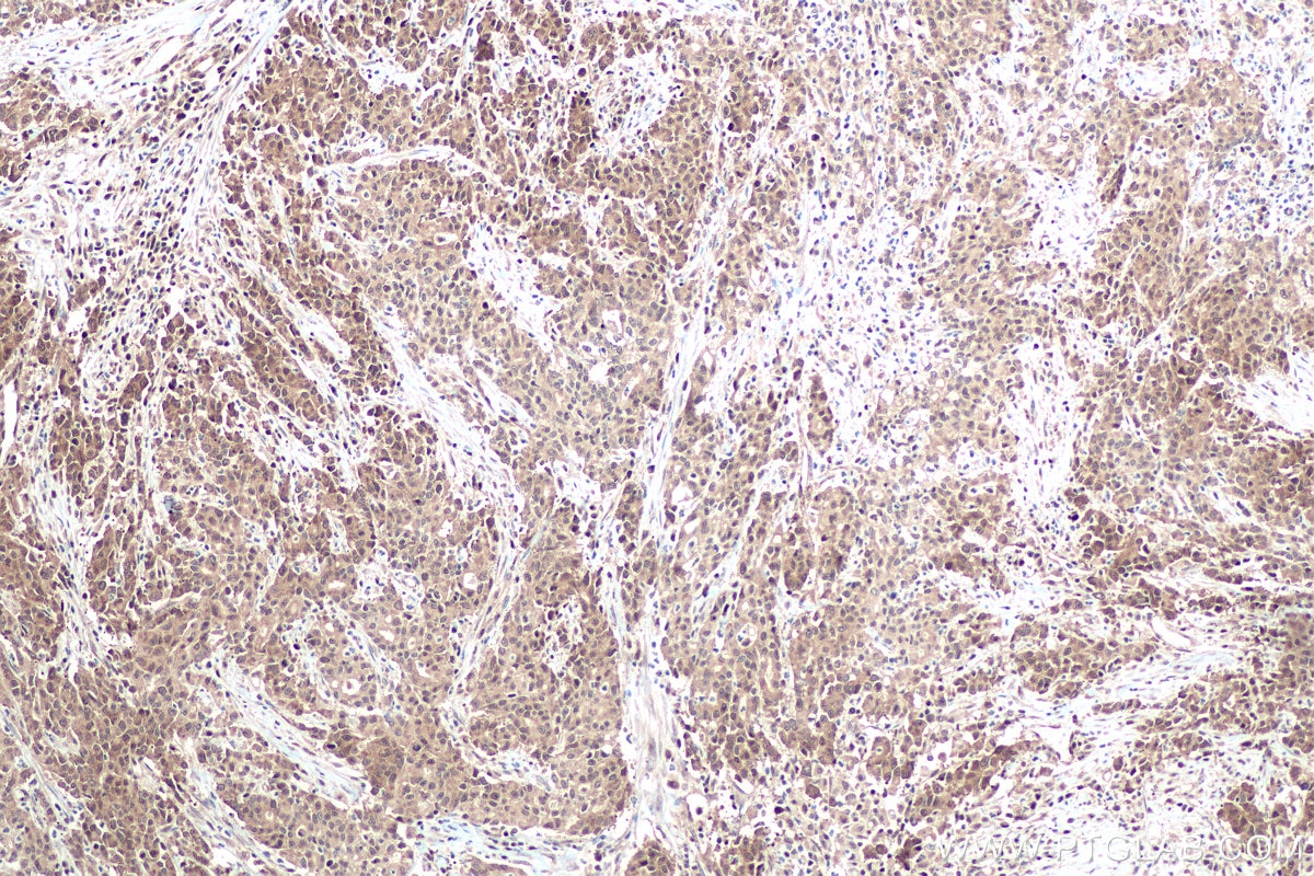 Immunohistochemical analysis of paraffin-embedded human stomach cancer tissue slide using KHC0913 (DDX5 IHC Kit).