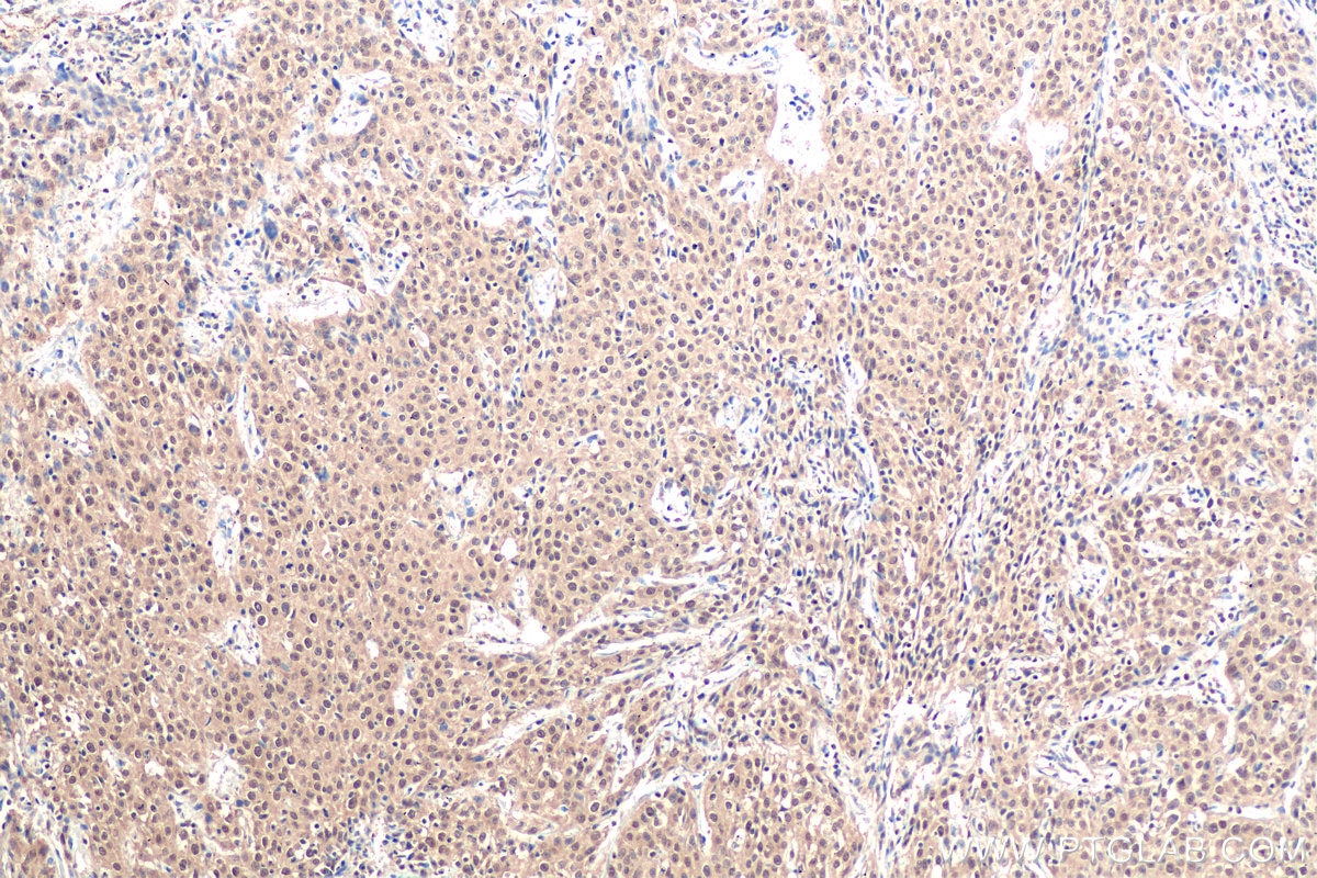 Immunohistochemical analysis of paraffin-embedded human cervical cancer tissue slide using KHC0913 (DDX5 IHC Kit).