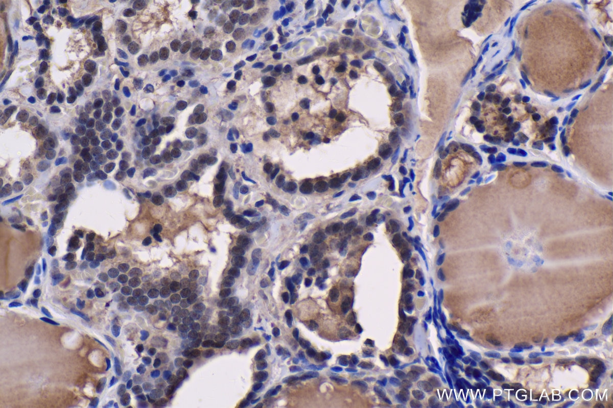 Immunohistochemical analysis of paraffin-embedded human thyroid cancer tissue slide using KHC1473 (DEAF1 IHC Kit).