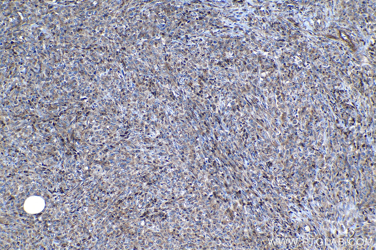 Immunohistochemical analysis of paraffin-embedded human lymphoma tissue slide using KHC1195 (DEF6 IHC Kit).