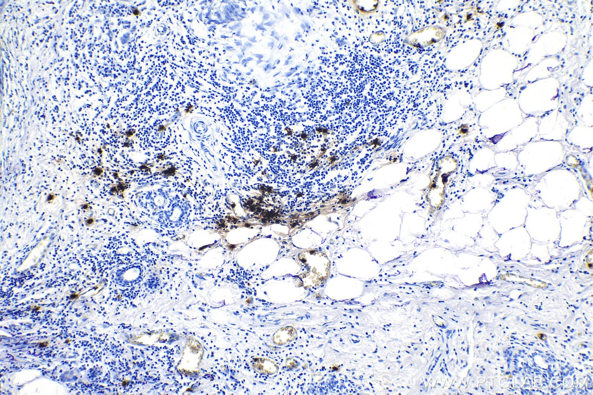 Immunohistochemical analysis of paraffin-embedded human breast cancer tissue slide using KHC1167 (DEFA1 IHC Kit).