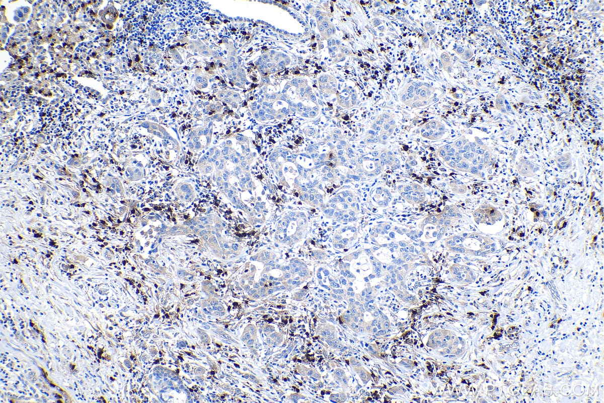 Immunohistochemical analysis of paraffin-embedded human lung cancer tissue slide using KHC1168 (DEFA3 IHC Kit).
