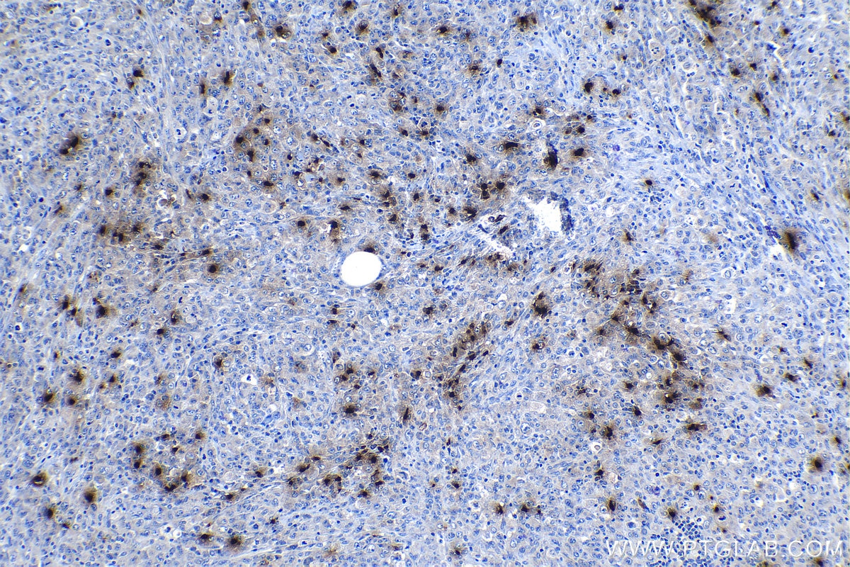 Immunohistochemical analysis of paraffin-embedded human lymphoma tissue slide using KHC1168 (DEFA3 IHC Kit).