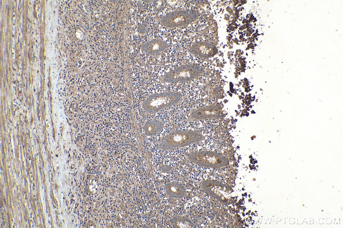 Immunohistochemical analysis of paraffin-embedded human appendicitis tissue slide using KHC1623 (DGKQ IHC Kit).