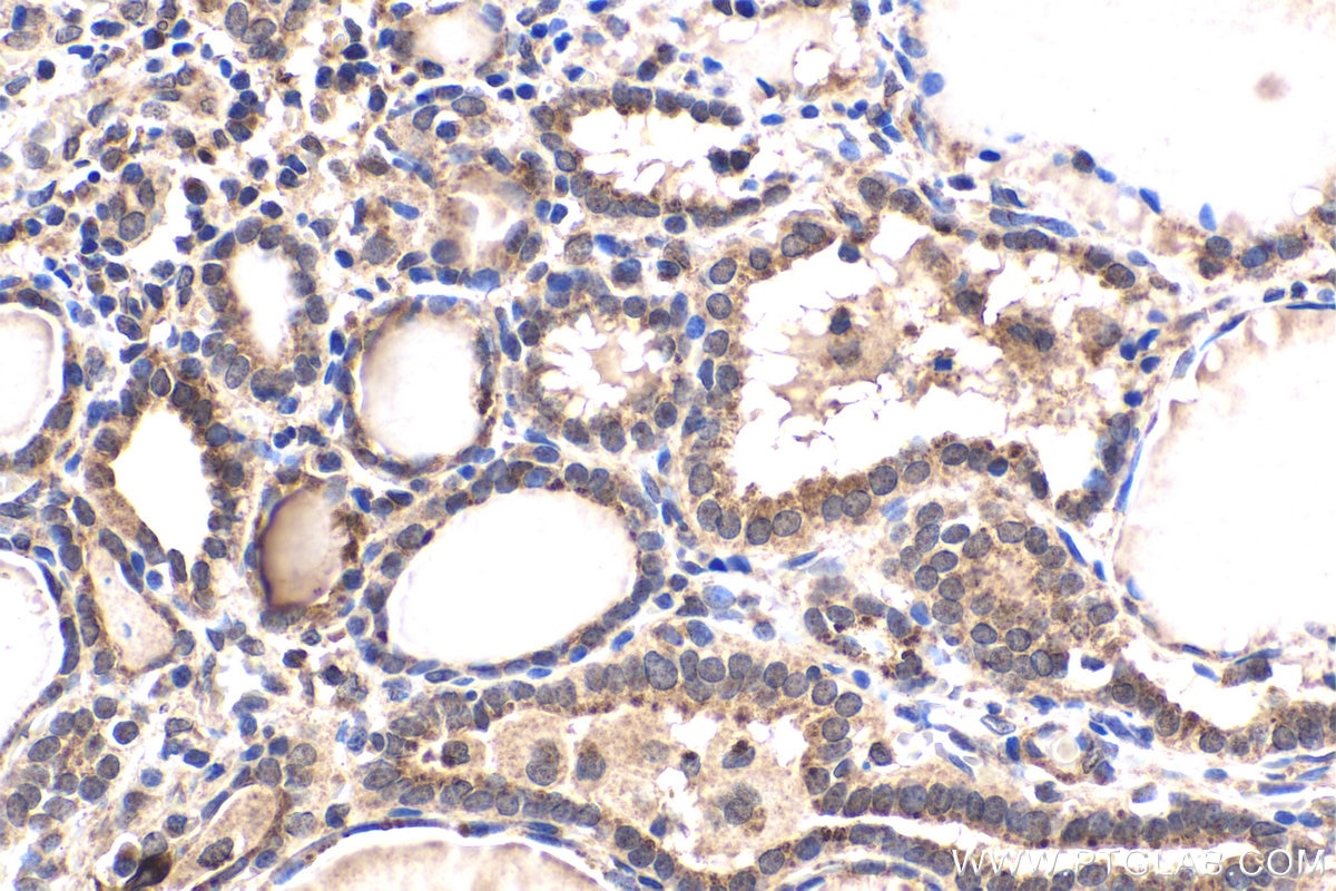 Immunohistochemical analysis of paraffin-embedded human thyroid cancer tissue slide using KHC1623 (DGKQ IHC Kit).