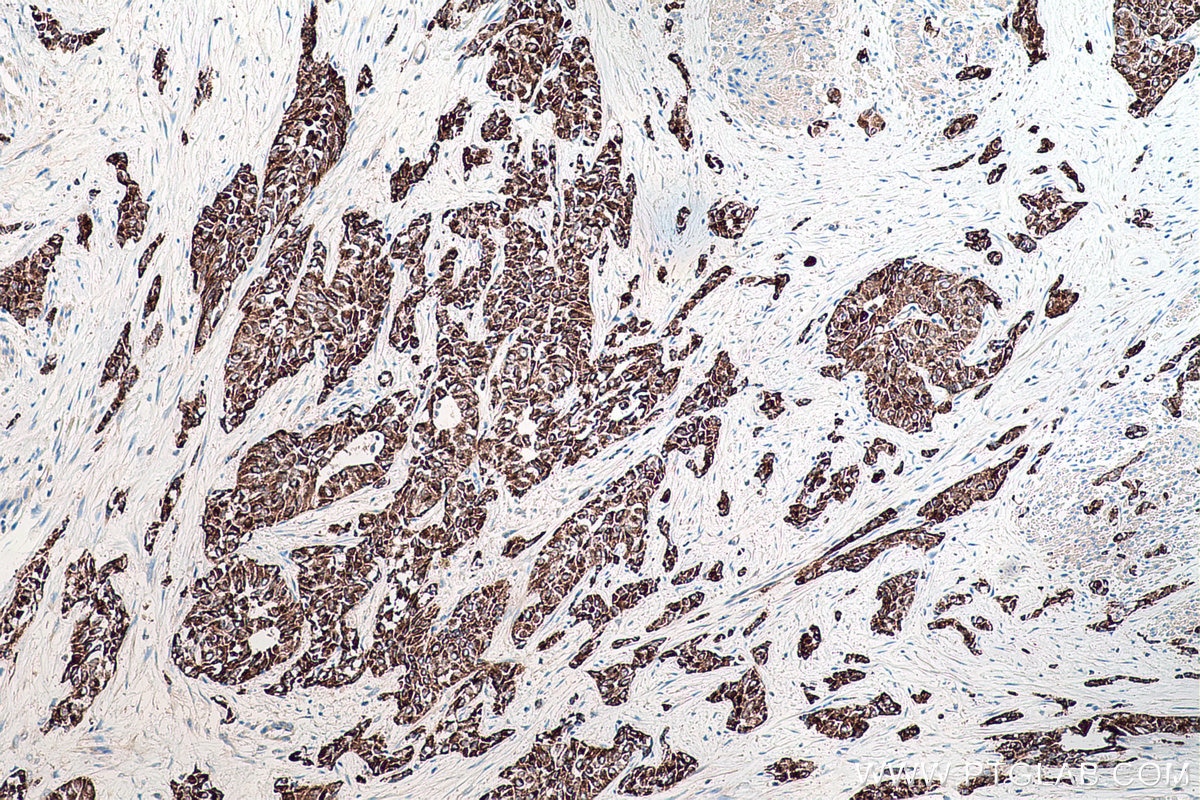 Immunohistochemical analysis of paraffin-embedded human urothelial carcinoma tissue slide using KHC0193 (DHRS2 IHC Kit).