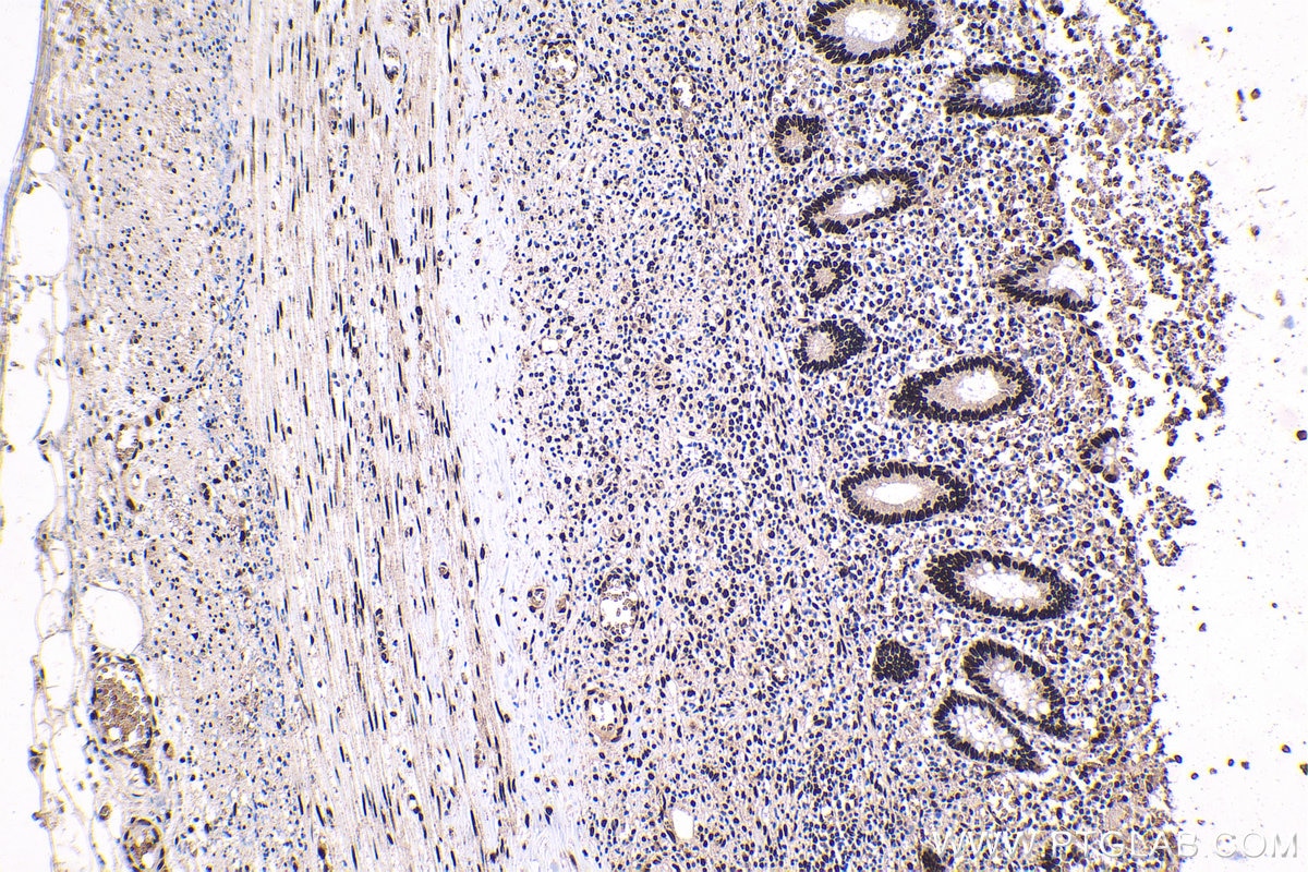 Immunohistochemical analysis of paraffin-embedded human appendicitis tissue slide using KHC1685 (DHX9 IHC Kit).