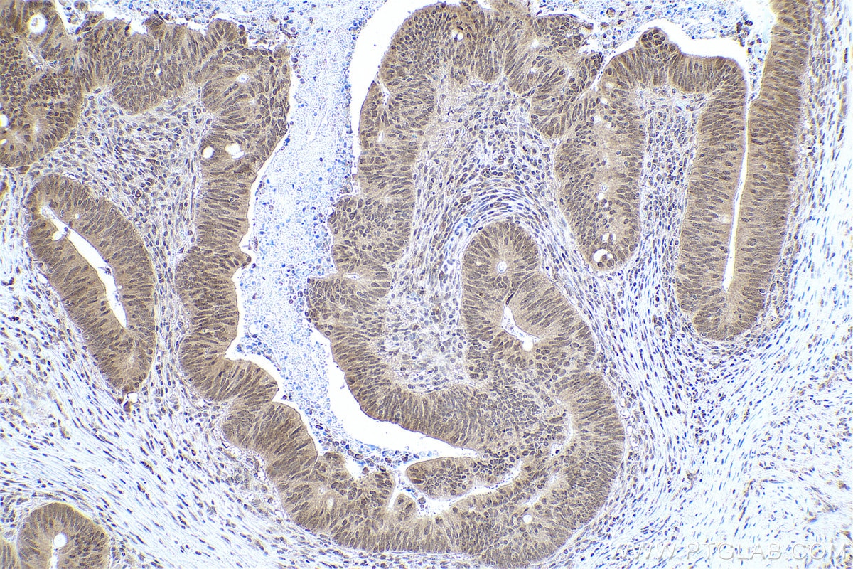 Immunohistochemical analysis of paraffin-embedded human colon cancer tissue slide using KHC0813 (DIDO1 IHC Kit).