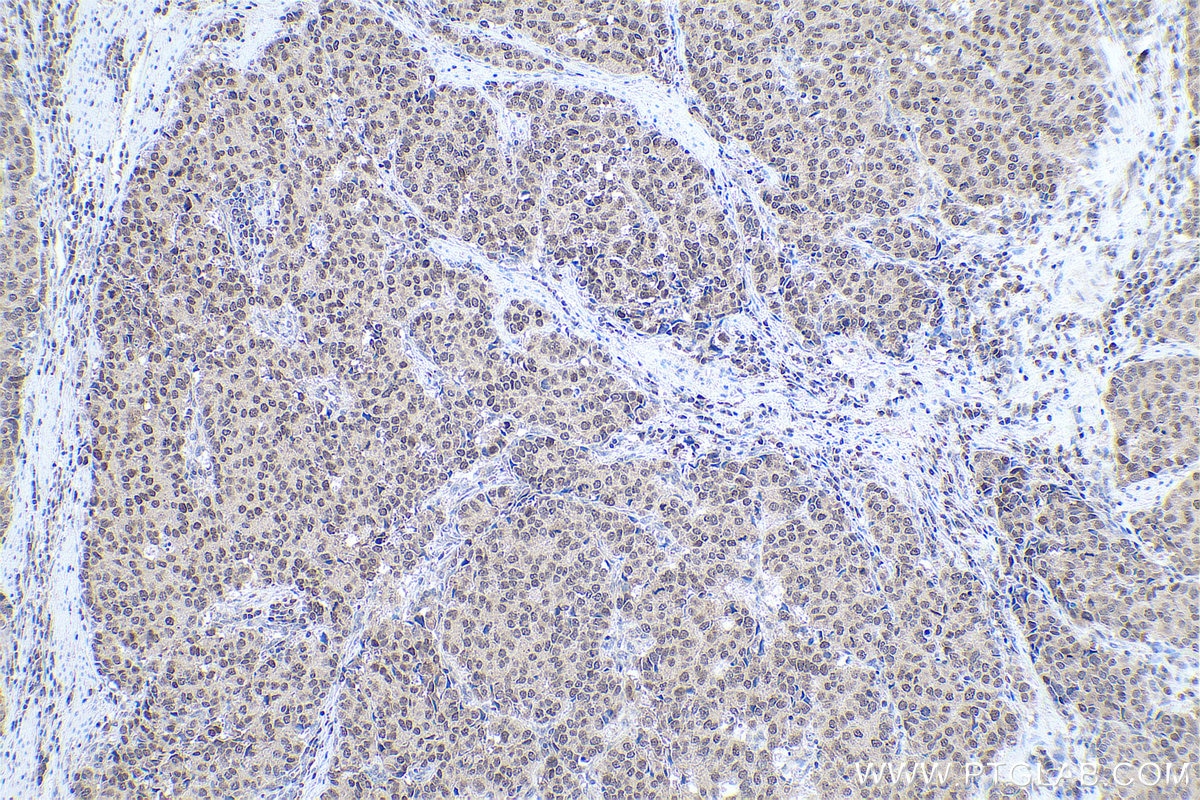 Immunohistochemical analysis of paraffin-embedded human stomach cancer tissue slide using KHC0813 (DIDO1 IHC Kit).