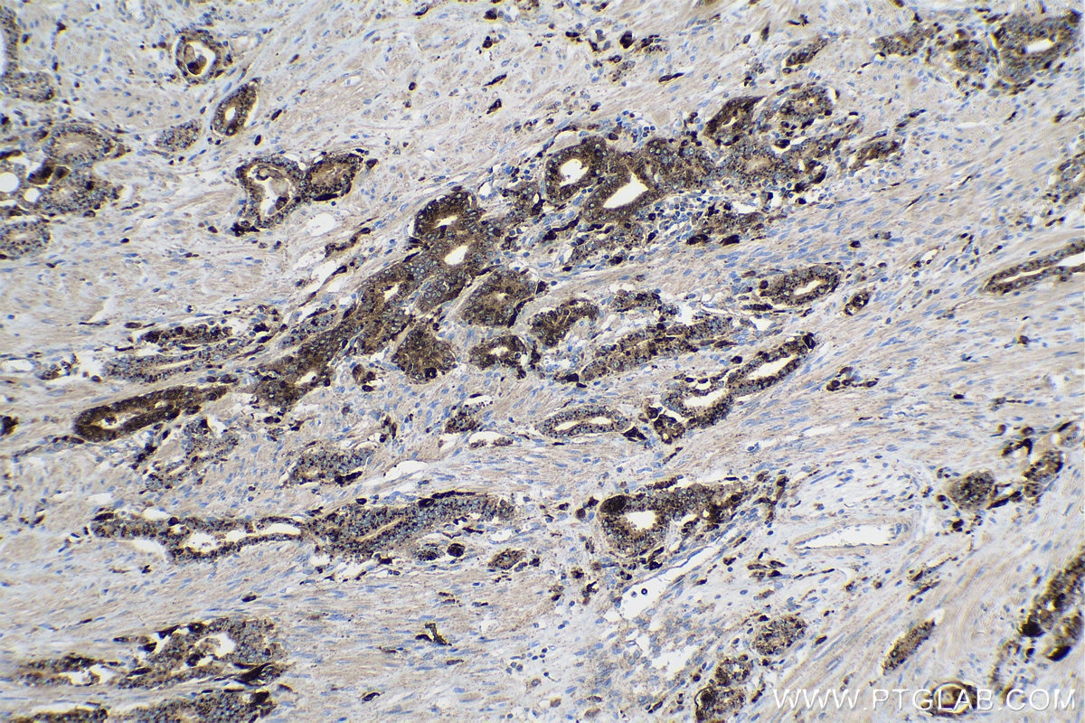 Immunohistochemical analysis of paraffin-embedded human prostate cancer tissue slide using KHC0252 (DIO2 IHC Kit).