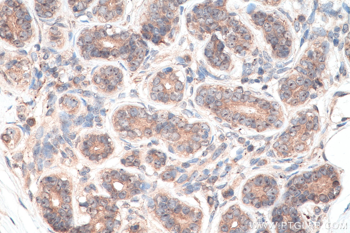 Immunohistochemical analysis of paraffin-embedded human breast cancer tissue slide using KHC0186 (DKC1 IHC Kit).
