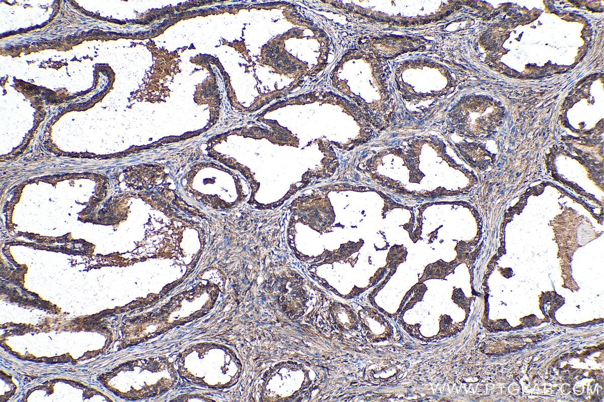 Immunohistochemical analysis of paraffin-embedded human prostate cancer tissue slide using KHC0119 (DKK3 IHC Kit).
