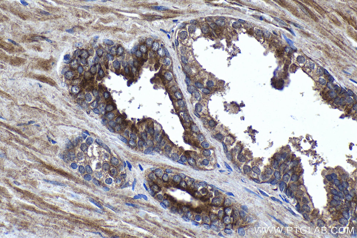 Immunohistochemical analysis of paraffin-embedded human prostate hyperplasia tissue slide using KHC1083 (DLEC1 IHC Kit).